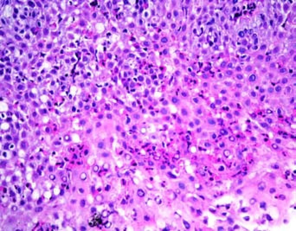 Epitel jícnu v barvení hematoxylin-eosin (1 HPF).
Fig. 2. Esophageal epithelium – hematoxylin-eosin staining (1 HPF).