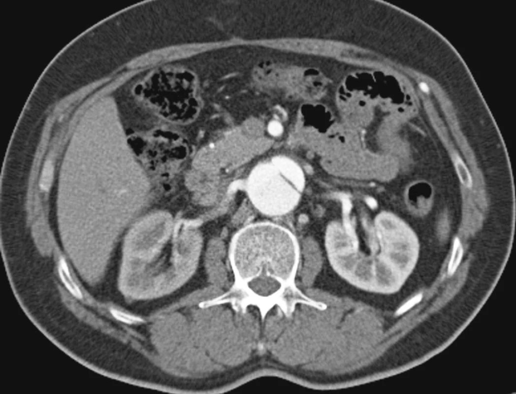 Pravá renální tepna plněna z nepravého lumen
Pic. 14. The right renal artery supplied from the false lumen