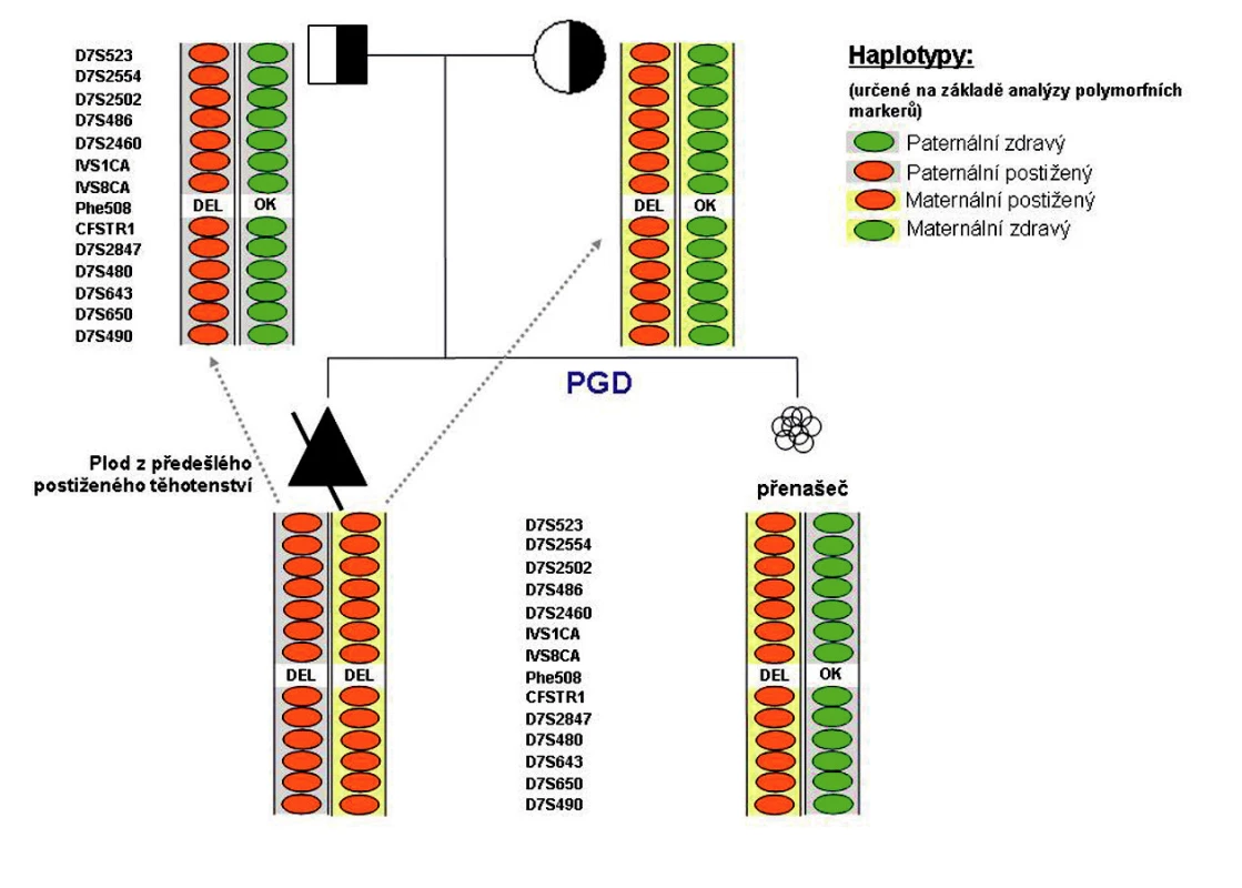 Příklad CFTR-PGH provedené na našem pracovišti: 
Oba partneři byli přímou analýzou diagnostikováni jako heterozygoti pro mutaci F508del. Analýza polymorfních markerů plodu z předešlého postiženého těhotenství umožnila určení rodičovských haplotypů, tj. bylo možné jednoznačně určit, který polymorfismus se váže se zdravou a který s postiženou alelou vyšetřovaného genu u daného rodiče. Tyto jednoznačně informativní polymorfismy jsou pak vyhledávány u vyšetřovaných embryí. V rámci preimplantační diagnostiky provedené na našem pracovišti bylo jedno z vyšetřovaných embryí (nesoucí mutaci F508del v heterozygotním stavu) páru určeno jako vhodné k transferu.