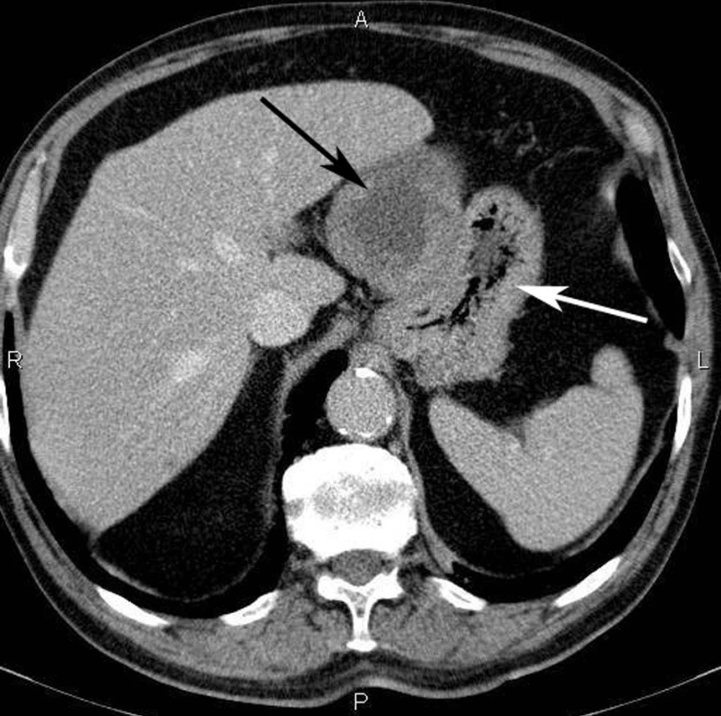 Spirální CT vyšetření břicha; velký, dobře ohraničený tumor (černá šipka) vyrůstá ze stěny žaludku (bílá šipka)
Fig. 2: Spiral CT scan of the abdomen showing a well circumscribed bulky GIST (black arrow) growing from the stomach wall (white arrow)