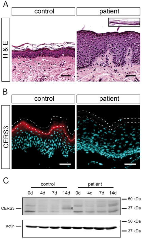 Histological analysis and CERS3 protein expression in skin biopsies and cultured keratinocytes from healthy controls and patient H.