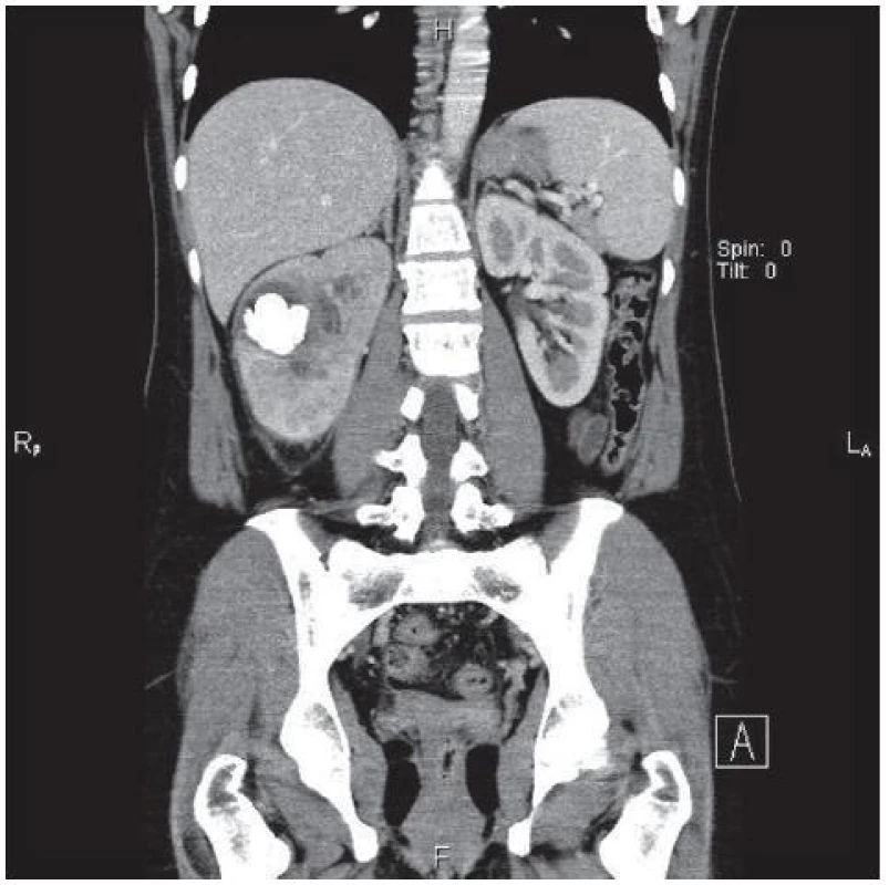 CT snímek tumoru
Fig. 1. CT of tumou