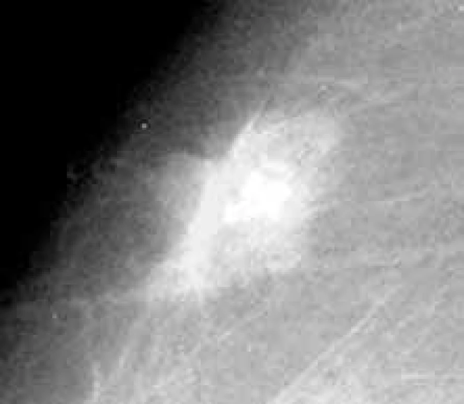 Detail neostře ohraničené plošné opacity bez obsahu mikrokalcifikací. Histologicky invazivní duktální a lobulární karcinom, grade 2, oba steroidní receptory vysoce pozitivní.