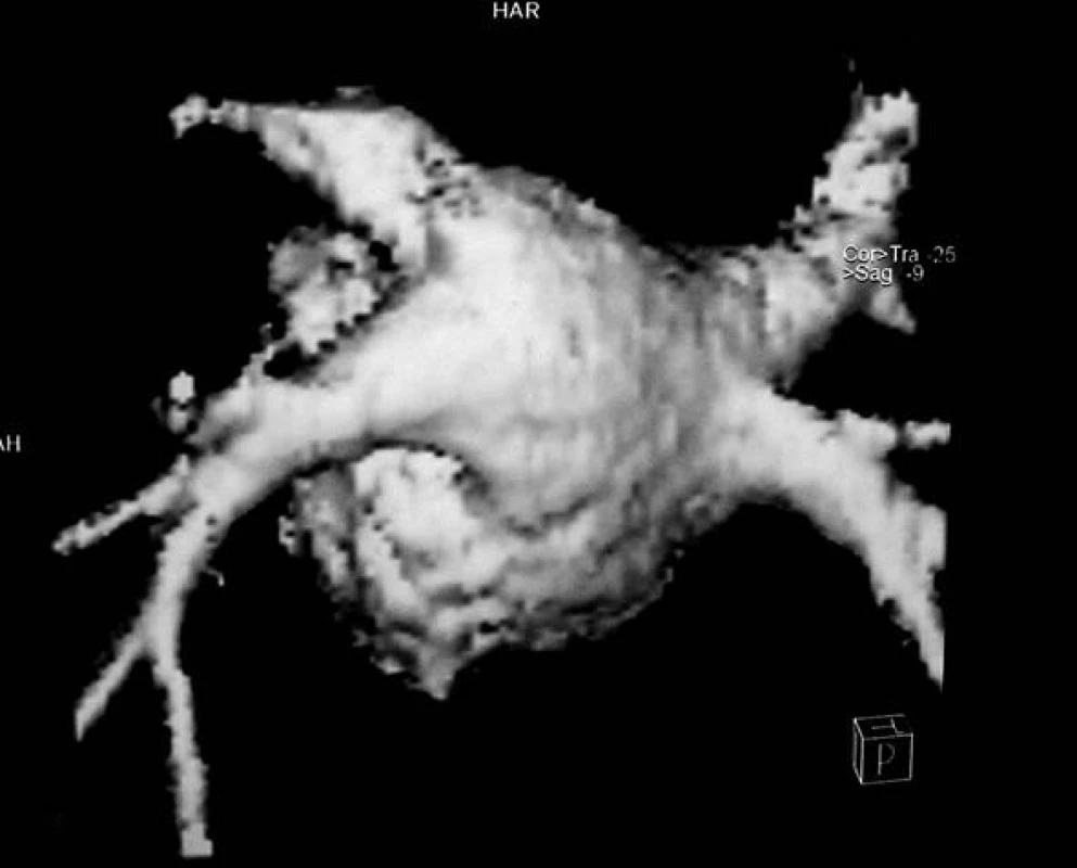 MRI trojrozměrná rekonstrukce vústění plicních žil do levé síně.