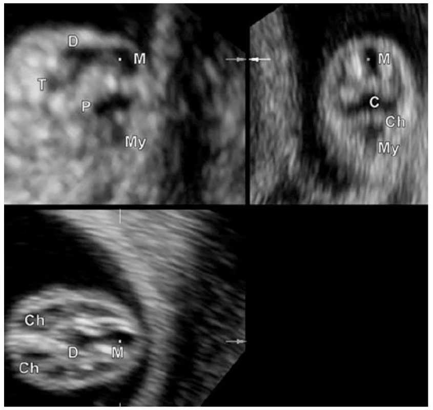 UZ embrya v 10. týdnu gestace. Zobrazení v mediosagitální, frontální a transverzální rovině (roviny řezů označeny). CRL = 24 mm.
T – telencefalon, D – diencefalon, M – mezencefalon, P – pontinní flexura, C – cerebellum, Ch – choroidní plexy, My – myelencefalon