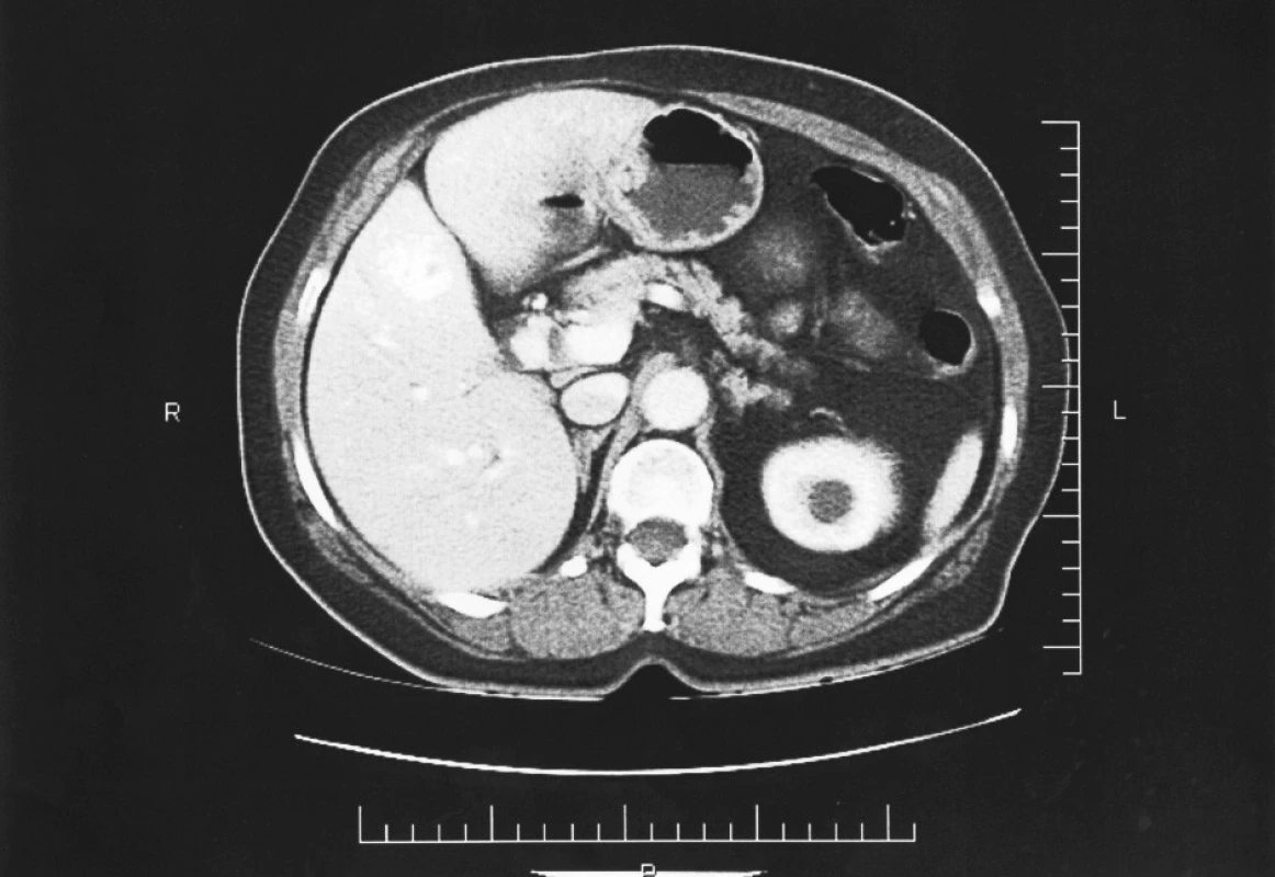 Předoperační CT jater s metastázou
Fig. 2. Preoperative liver CT with a metastasis