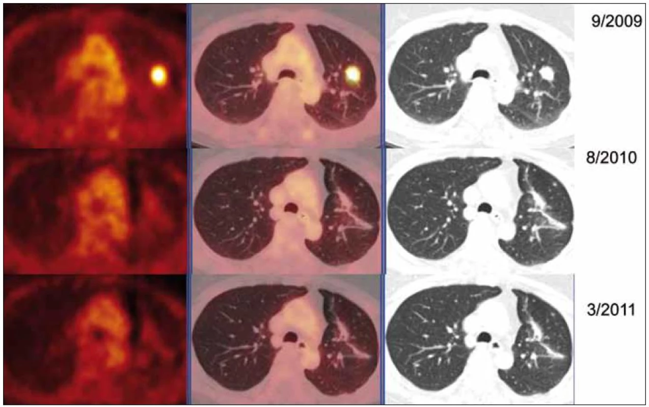PET-CT zobrazení plicních ložisek v čase (září roku 2009, srpen roku 2010, březen roku 2011), axiální řezy, ve sloupcích zleva PET, PET/CT a CT. PET obraz je v barevné škále „Hot Body“, řazeno odshora. Metabolicky aktivní ložisko (SUV<sub>max</sub> 8,03 velikosti 20 × 16 mm) v S1/2 v levém plicním křídle bylo patrné pouze na vyšetření v září roku 2009, toto ložisko bylo operativně odstraněno, a proto dále pozorujeme jen jizevnaté změny, bez vývoje.