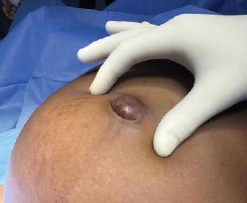 Rezistence v umbiliku. Fig. 1. Umbilical nodule.