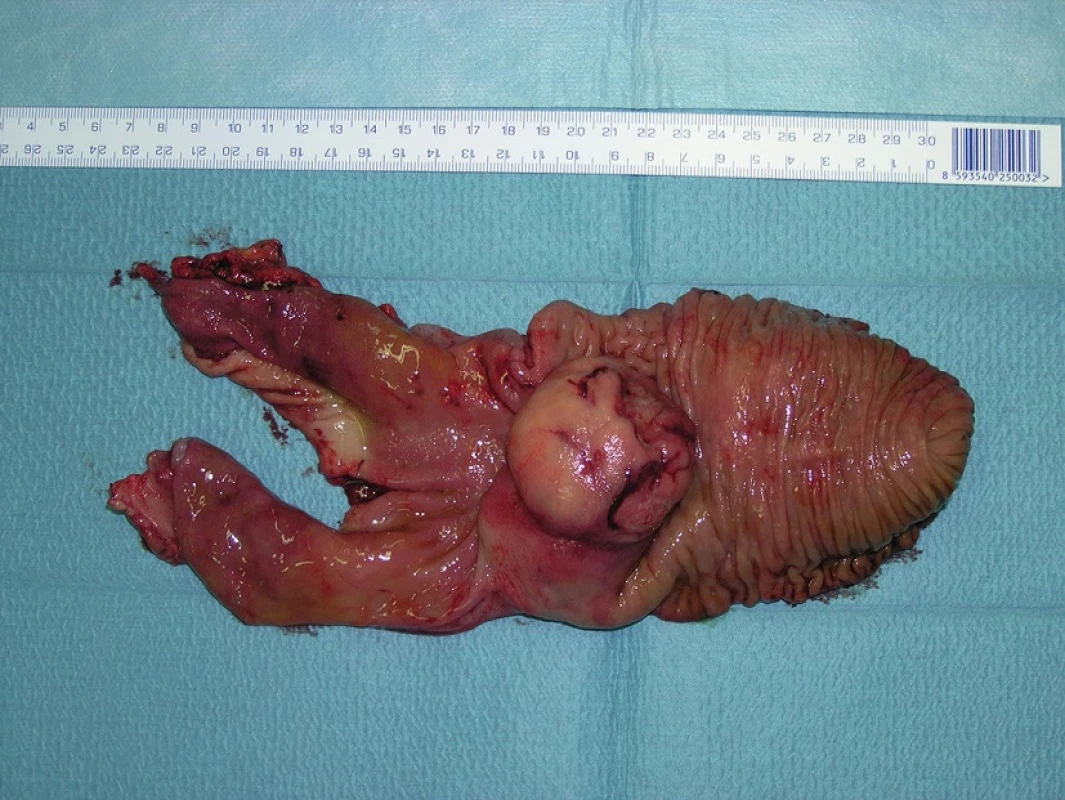GIST of the duodenum – resected specimen