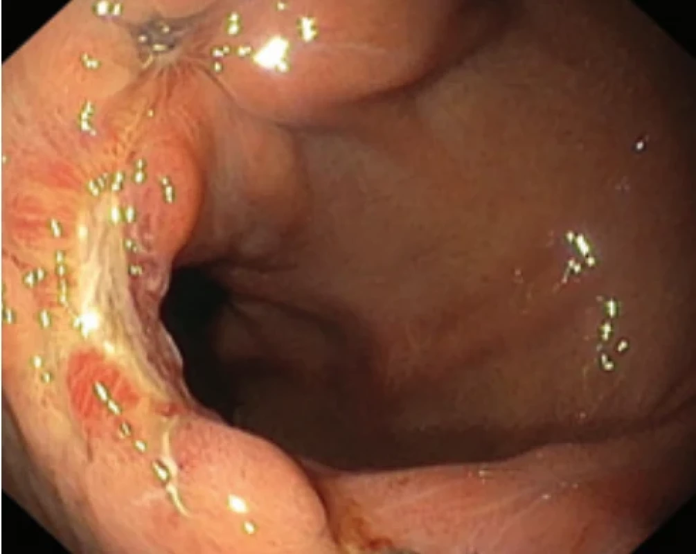 Hojící se ulcerace po resekci septa a široce zející vstup do sleevu. Fig. 3. Healing ulceration following resection of the septum and a widely gaping opening into the sleeve.