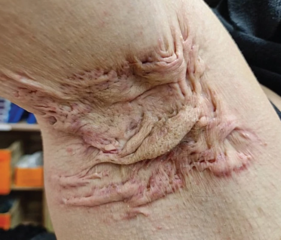Keliodné jazvy v axile u pacientky s HS (zdroj: archív Kliniky dermatovenerológie UNLP Košice).