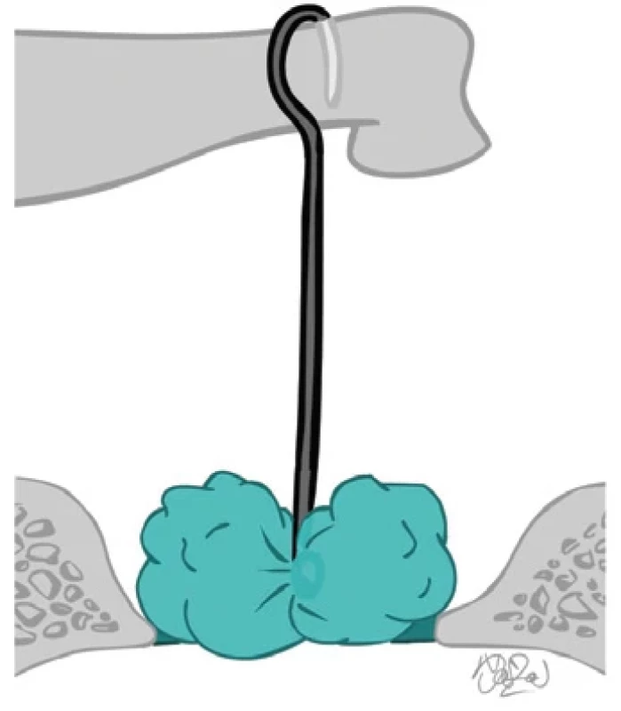 Schuknechtova protéza. Fig. 1. Schuknecht´s protesis.