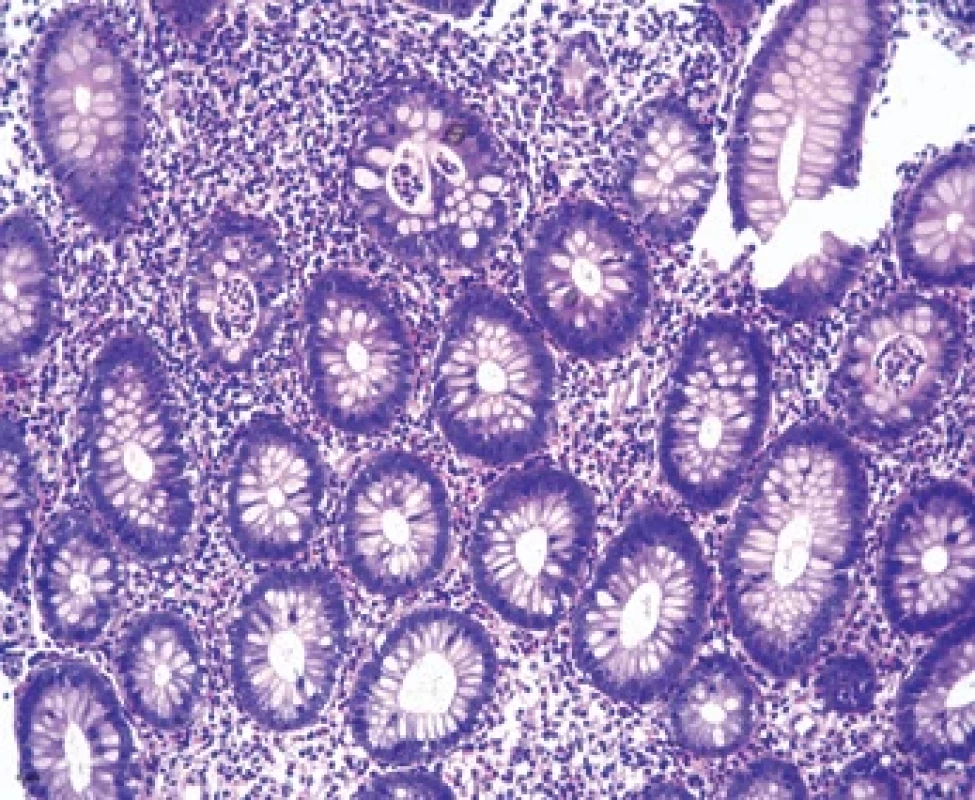 Vzorek z etážové biopsie tlustého střeva u pacienta s CVID a kolitidou. Patrná je chronická kolitida s větvením žlázek a aktivitou zánětu v podobě kryptitidy a kryptových abscesů morfologicky připomínající ulcerózní kolitidu. Barvení: hematoxylin- -eozin, zvětšení 200×. Fig. 􀍼. Sample from a colon biopsy in a patient with CVID and colitis. Chronic colitis with branching glands and infl ammatory activity in the form of cryptitis and crypt abscesses morphologically resembling ulcerative colitis is evident. Staining: hematoxylin-eosin, magnifi cation 200×.
