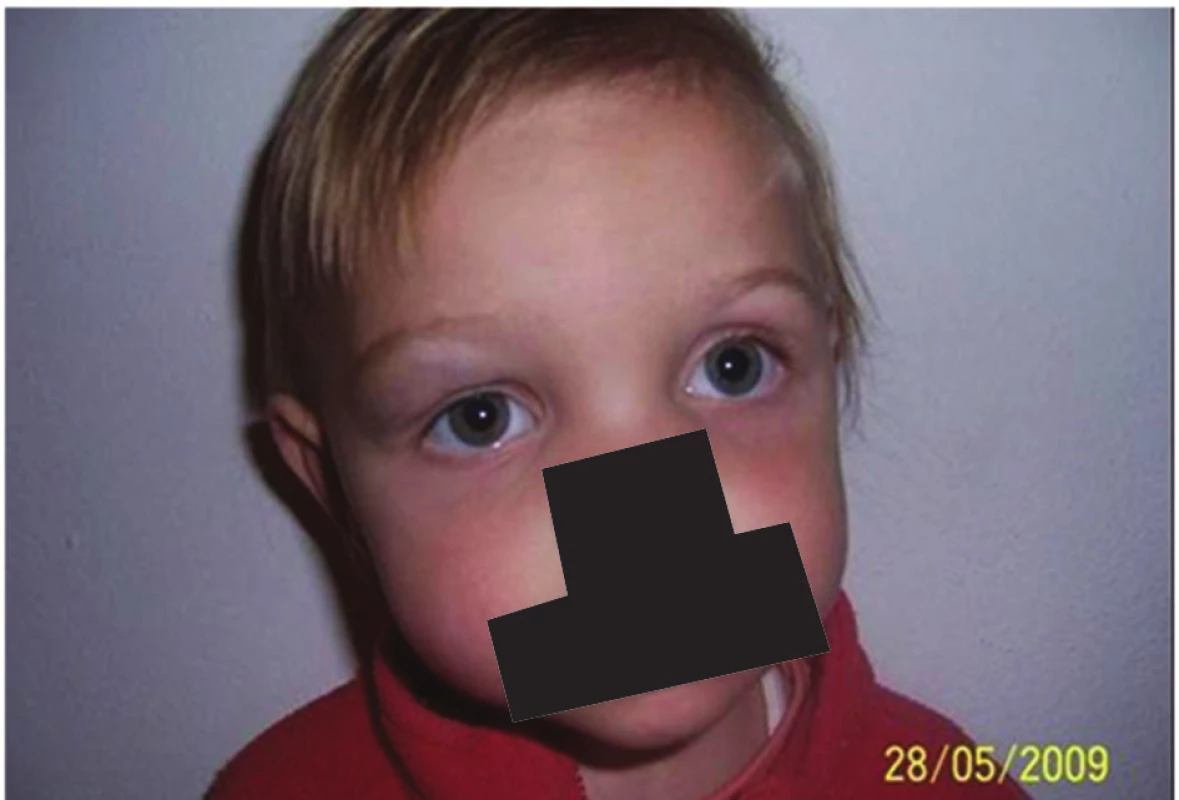 Dvouletá holčička po ukončení léčby