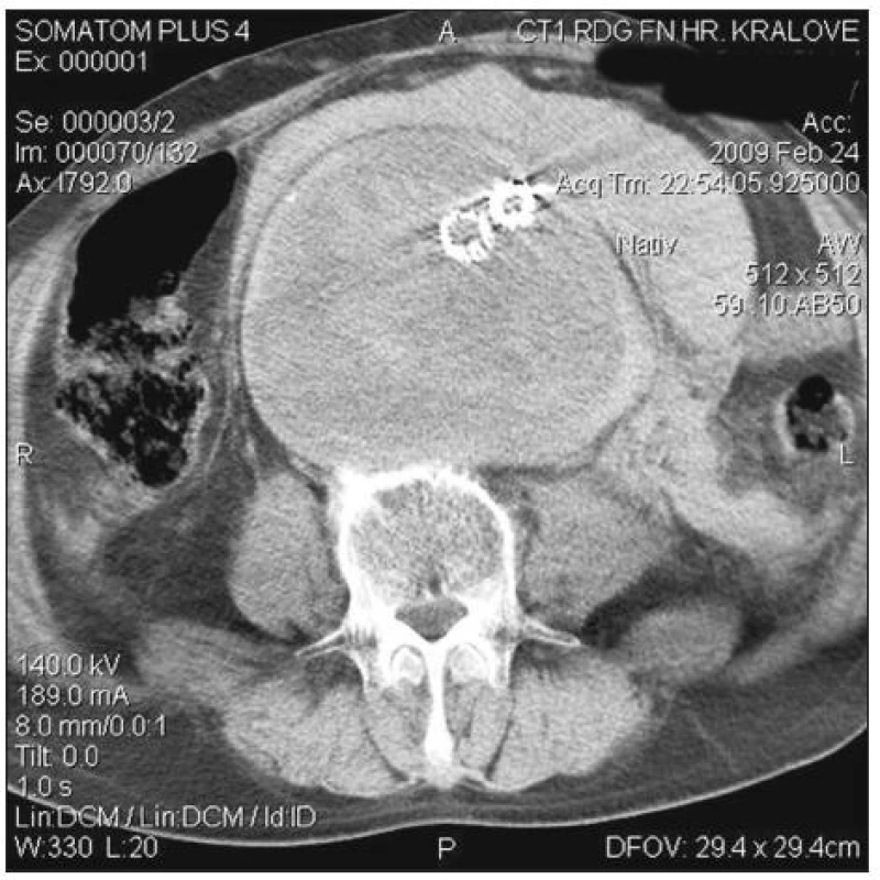 Urgentní CT 6 hodin po endovaskulárním ošetření (zvětšení vaku, retroperitoneální hematom)
Fig. 4. An urgent CT 6 hours after endovascular treatement (enlargement of sac, retroperitoneal hematoma)
