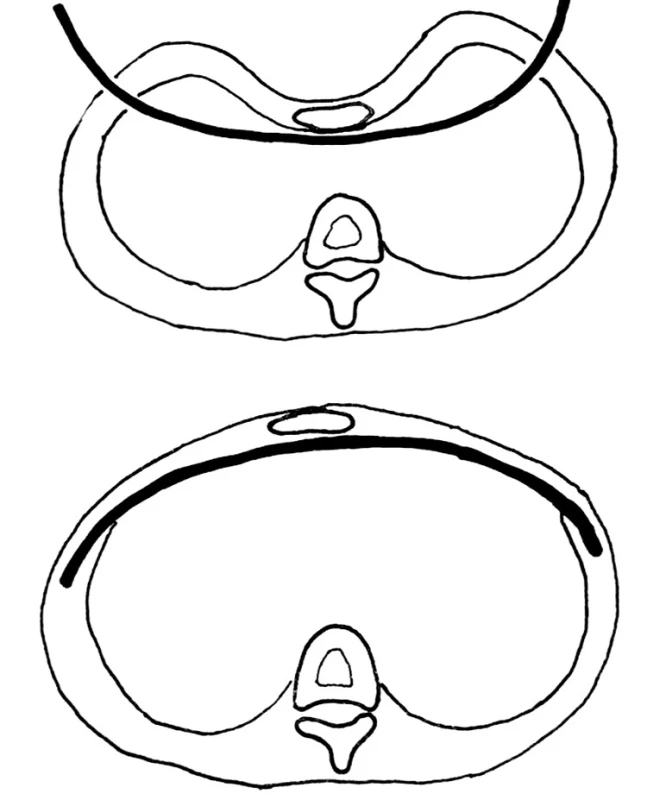 Princip Nussovy operace. Elevace vpáčeného hrudníku zavedením kovové dlahy
Fig. 1: The principle of the Nuss operation. Elevation of the depressed chest wall with metal bar insertion.