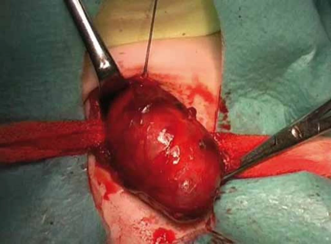 Thyroid nodule of right lobe.