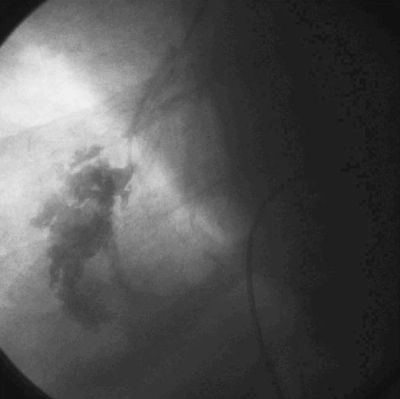 Extravazace kontrastní látky 3 sekundy po perforaci plicní artérie
Fig. 2. Extravasation of the contrast matter 3 seconds following perforation of the pulmonary artery