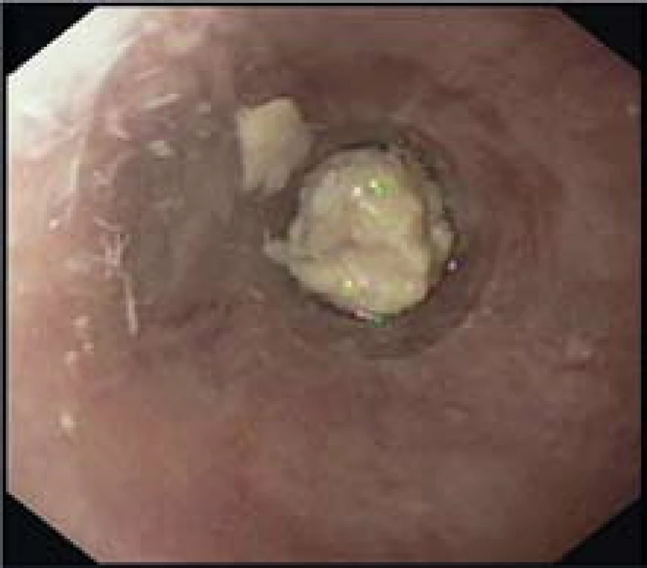 Zaklíněné tuhé sousto u pacienta s dg. EoE ve zúženém distálním jícnu.
Fig. 9. Impacted solid food in a patient with EoE in the narrow distal esophageal.