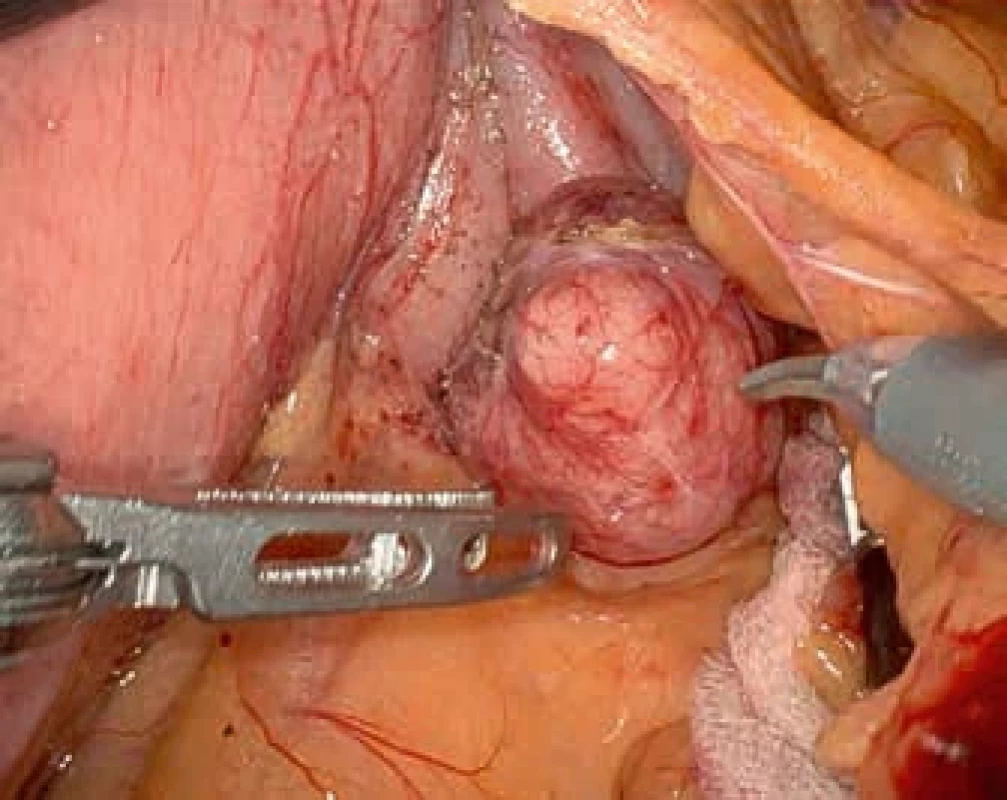 Peroperační pohled na divertikl zadní stěny žaludku z omentální burzy. Intraoperative view of a diverticulum on the posterior wall of the stomach from the lesser sac.
