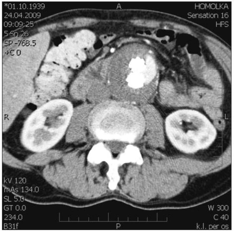 EL při boční stěně vaku AAAsouvisející s odstupem a. mesenterica inferior
Fig. 5. EL at the lateral AAA sac wall, related to the a. mesenterica inferior