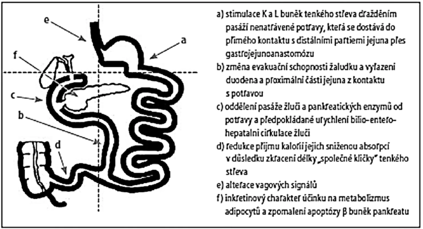 Antidiabetický účinek biliopankreatické diverze (BPD)