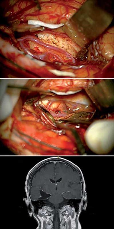 Přímý transsylvijský přístup přes sulcus periinsularis inferior.
Fig. 5. Direct trans-sylvian access via sulcus periinsularis inferior.
