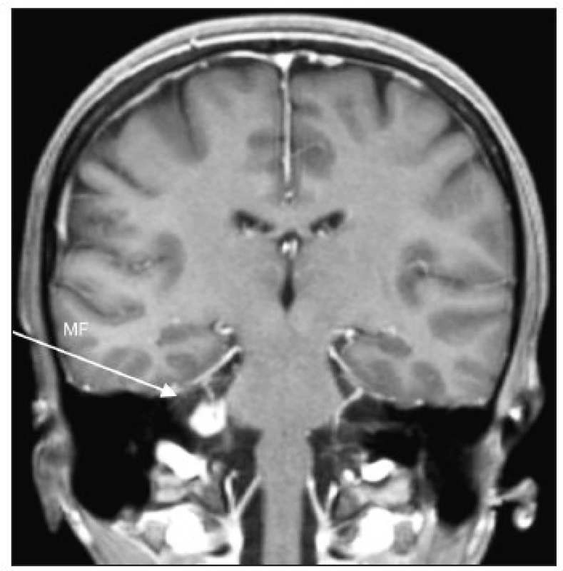 Vestibulárny schwannom vpravo veľkosti 1,2 cm v koronárnom reze. Šípka znázorňuje, že takýto tumor je možné tiež odstrániť rozšíreným prístupom cez strednú lebečnú jamu, ak tento prístup operatér preferuje. Rovnako sú možné aj ďalšie dva prístupy – retrosigmoidný a translabyrintný, indikáciu v tomto prípade určí stav sluchu a skúsenosti operatéra.