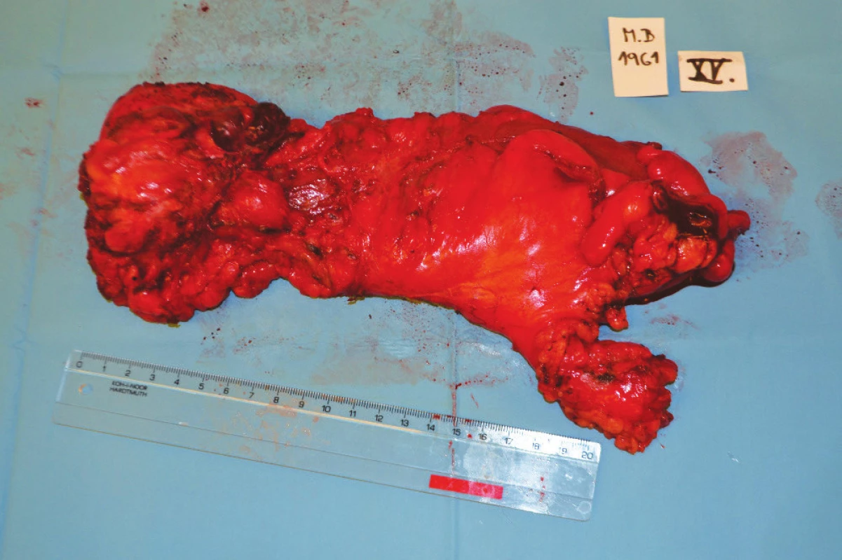 Resekát rekta
Fig. 6: Rectal specimen