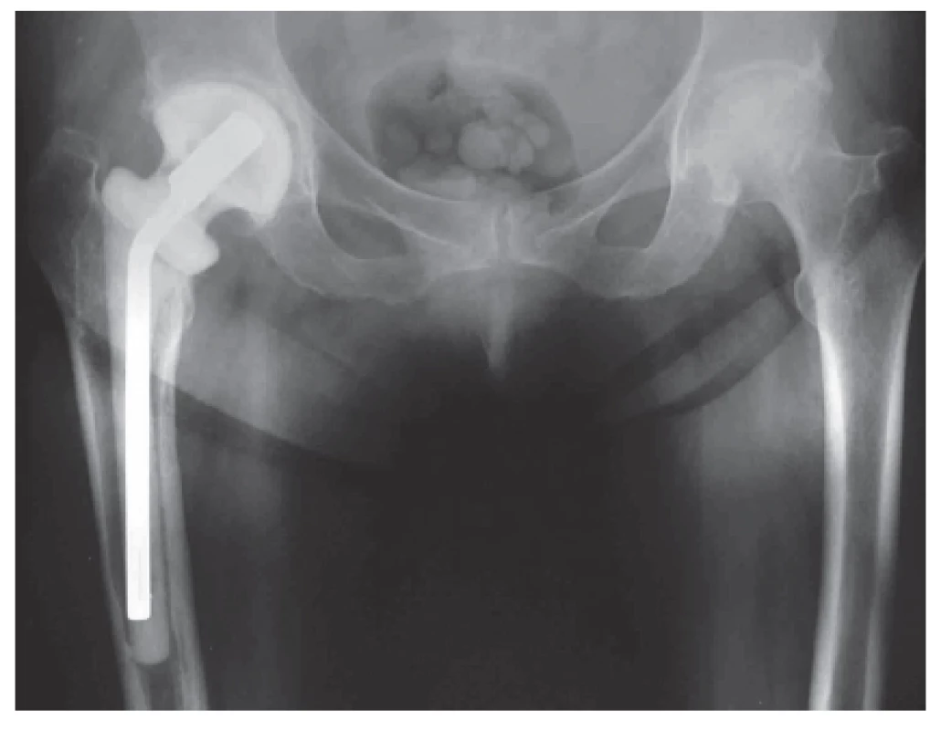 Rentgenový snímek implantovaného ready-made spaceru kyčelního kloubu. Významnou výhodou je zachování délky končetiny.
Fig 1. An X-ray of an implanted ready-made total hip spacer, having the advantage of preserving limb length.