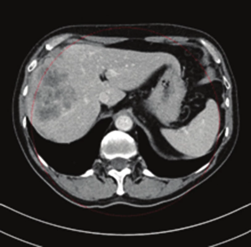 CT obraz metastatického postižení jater při karcinomu apendixu (venózní fáze, axiální řez)
Fig. 3: CT scan of liver metastases due to appendix cancer (venous phase, axial view)