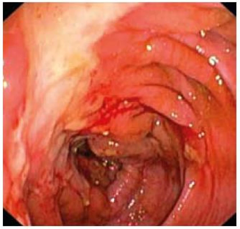 Tiahnuce sa ulcerácie sliznice colon ascendens.
Fig. 2. Far stretching ulcerations of mucosa in colon ascendens.