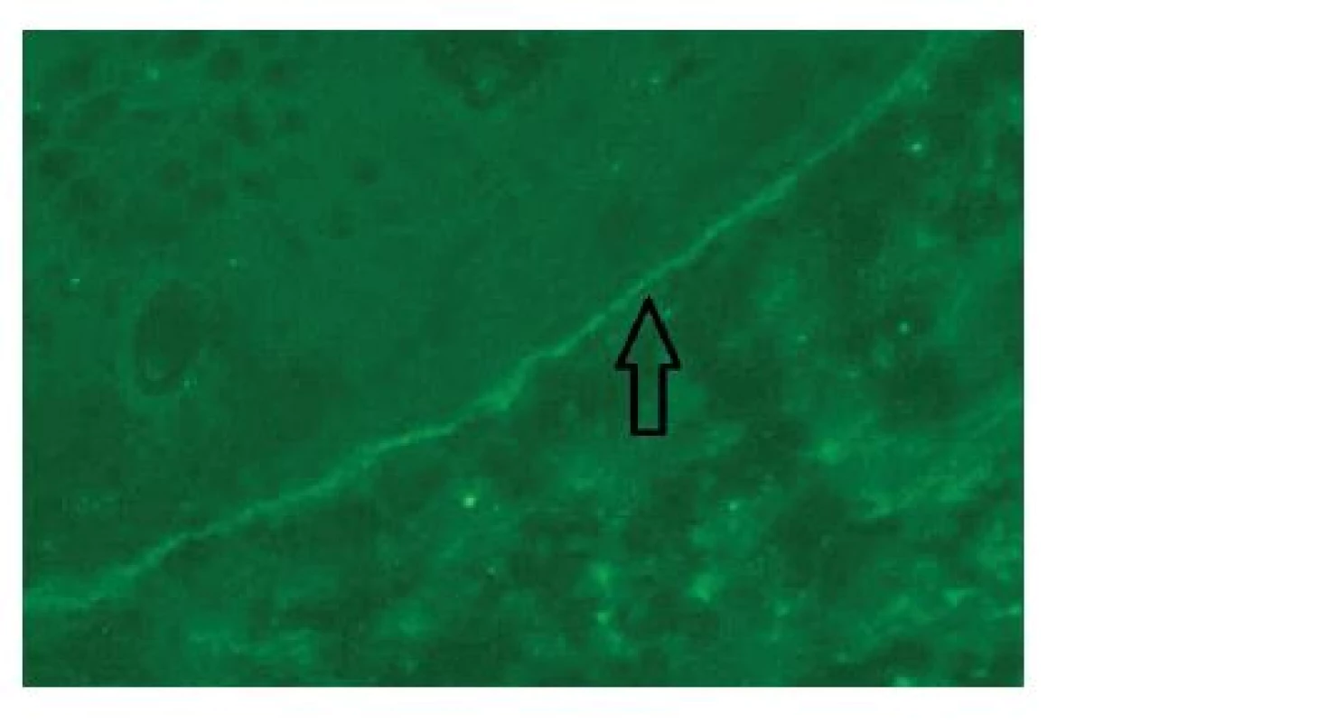 Vzorek sliznice ústní dutiny při vyšetření přímou imunofluorescencí, šipka ukazuje lineární fluorescenci proti bazální membráně epitelu.