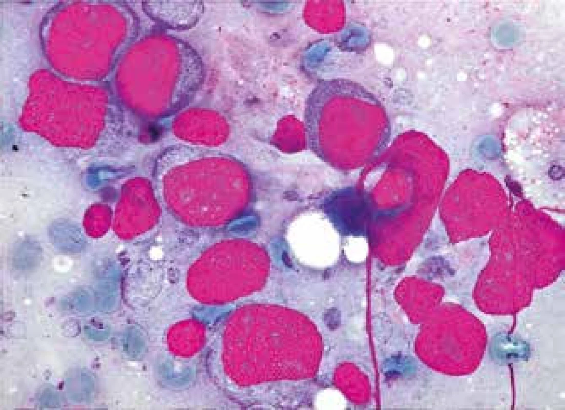 CD5+ DLBCL, centroblastická varianta (infiltrace lymfatické uzliny převažujícími centroblasty – středně velkými a velkými lymfocyty s bohatou bazofilní cytoplazmou, méně kondenzovaným jaderným chromatinem a výraznými vícečetnými nukleoly)