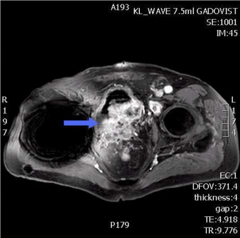 NMR pánve – pokročilý nádor močového měchýře
Fig. 3. Pelvic MRI – advanced bladder tumor