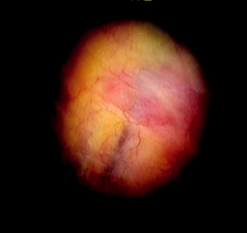 Pohľad na parietálnu pleuru bez postihnutia v bielom svetle, viditeľné je presvitanie interkostálnej svaloviny a cievnych štruktúr
Fig. 1. A view of unaffected parietal pleura, in white light. Intercostal musculature and vascular structures can be detected (show through)