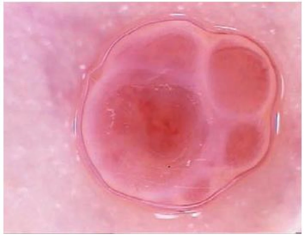 Granuloma pyogenicum
