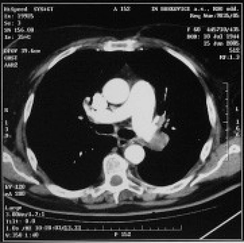 Vlevo masivní defekt v kontrastní náplni a. pulmonalis, vyplňující její lumen před odstupem dolní lobární větve v délce 35 mm a dále sledovatelný v celé délce dolní lobární větve. Vpravo defekt v dolní lobární větvi a. pulmonalis částečně obtékaný kontrastní látkou.