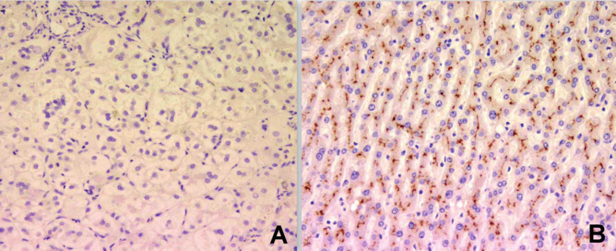 Imunohistochemické vyšetření u téhož kojence s cílenou protilátkou prokazuje absenci membránového BSEP proteinu (obr. A). Kontrolní imunohistochemické vyšetření normálních jater s vizualizací BSEP proteinu v kanalikulární membráně (obr. B) (vyšetření provedeno a obrázek zapůjčen s laskavostí: Alex Knisely, King´s College Hospital, London).

Fig. 3. Immunohistochemical examination in the same infant with specific antibody demonstrates absence of membrane BSEP protein (Fig. A). A control immunohistochemical examination of normal liver with visualization of BSEP protein in the canalicular membrane (Fig. B) (The examination was performed and the picture was kindly provided by Alex Knisely, King’s College Hospital, London).