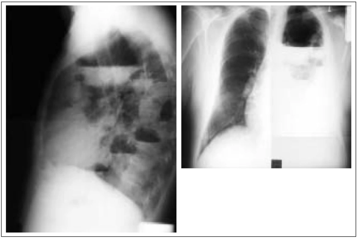 Mnohočetné abscesy levé plíce komplikované multilokulárním empyemem u 65letého muže s 15letou anamnézou DM 2 léčeného dietou a PAD.