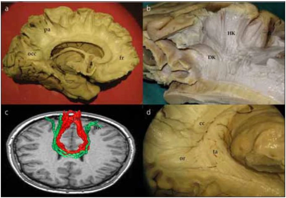 Preparace corpus callosum.
Obr. 2a) Komisurální vlákna corpus callosum jdoucí z frontálního (fr), parietálního (pa) a okcipitálního (occ) laloku.
Obr. 2b) Komisurální vlákna jdoucí z centrální krajiny pro horní (HK) a dolní (DK) končetinu – motorické corpus callosum.
Obr. 2c) Traktografické zobrazení komisurálních vláken pro dolní končetinu (DK) červená vlákna a horní končetinu (HK) zelená vlákna. Průběh virtuálních vláken zobrazených technikou DTI koreluje s průběhem vypreparovaných komisurálních vláken (B).
Obr. 2d) Tapetum (ta) ve vztahu k optické radiaci (or). cc – corpus callosum