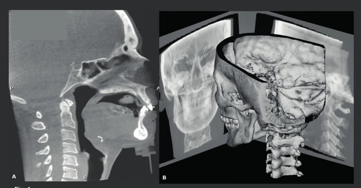 Rozšířené pole zobrazení (FOV) CBCT získané pomocí techniky dvojí rotace, která zahrnuje všechny potřebné struktury od hrtanu po čelo. Fúze snímků rozšířeného FOV CBCT, jeden z 360 (bočních) snímků použitých pro rekonstrukci 3D CBCT snímků (A). 3D CBCT snímky poskytují přesnější možnosti měření než konvenční RTG projekce hlavy. Jak 3D CBCT snímky, tak 2D projekce (snímky hlavy) vytvořené z těchto 3D CBCT snímků, lze vytvořit z CBCT datových souborů (B).