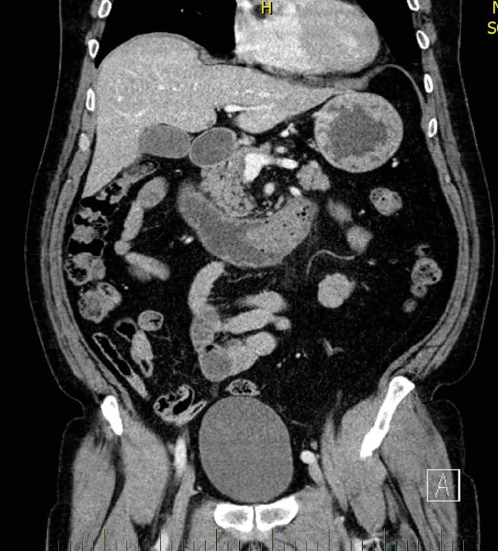 CT břicha, suspektní bezoár obturující duodenum Fig. 5: Abdominal CT, suspected bezoar obturating the duodenum