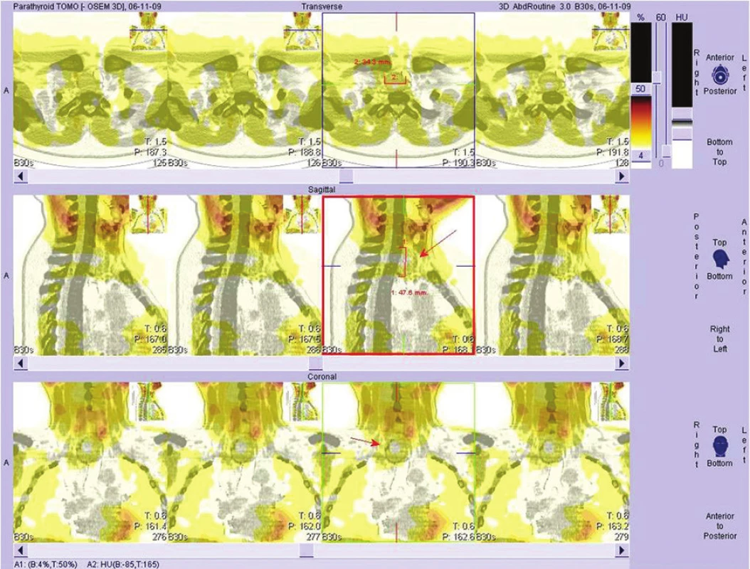 SPECT Scan
Fig. 2: SPECT Scan