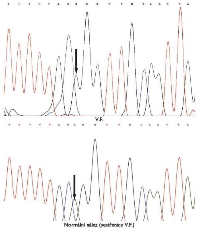 Analýza genomové DNA V.F. Sekvence 3’ konce intronu 1 a 5’ konce exonu 2. Mutace akceptorového sestřihového místa IVS1-2a>g.