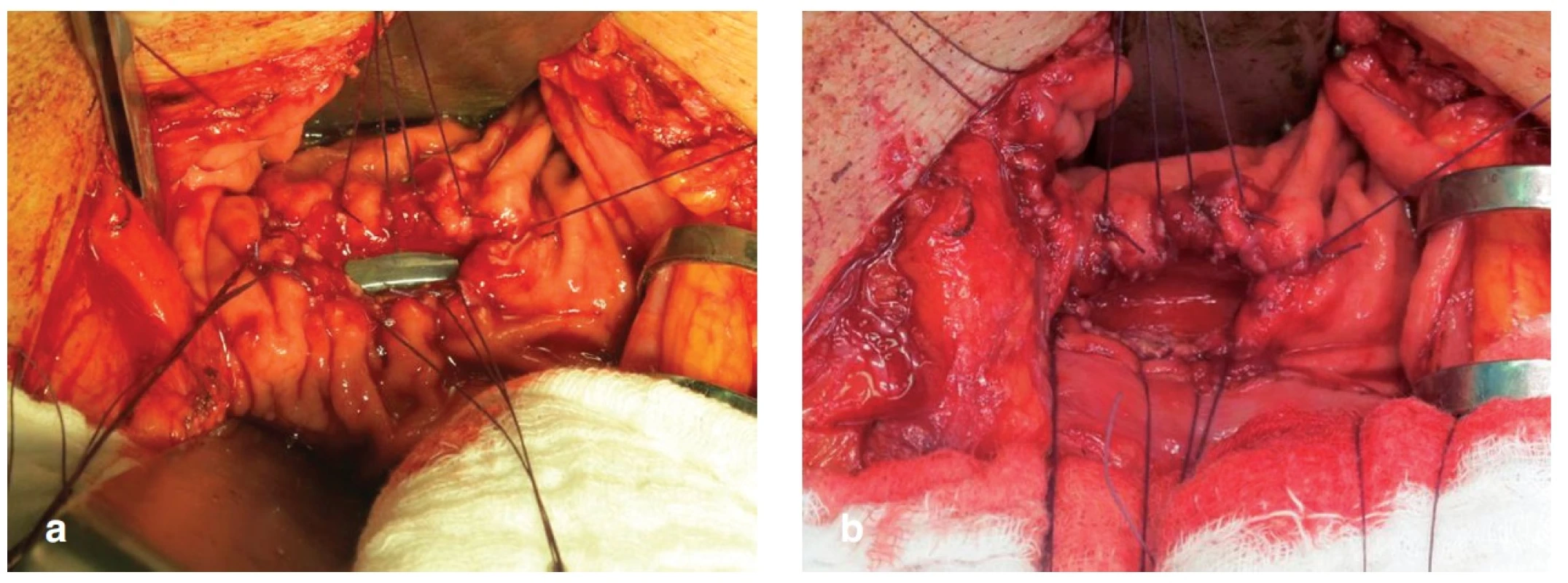 Kazuistika 1 – a) zadní gastrotomie nad zavedeným drénem, b) po vytažení drénu
Fig. 4: Case 1 – a) posterior gastrotomy over the drainage tube, b) drainage tube extraction