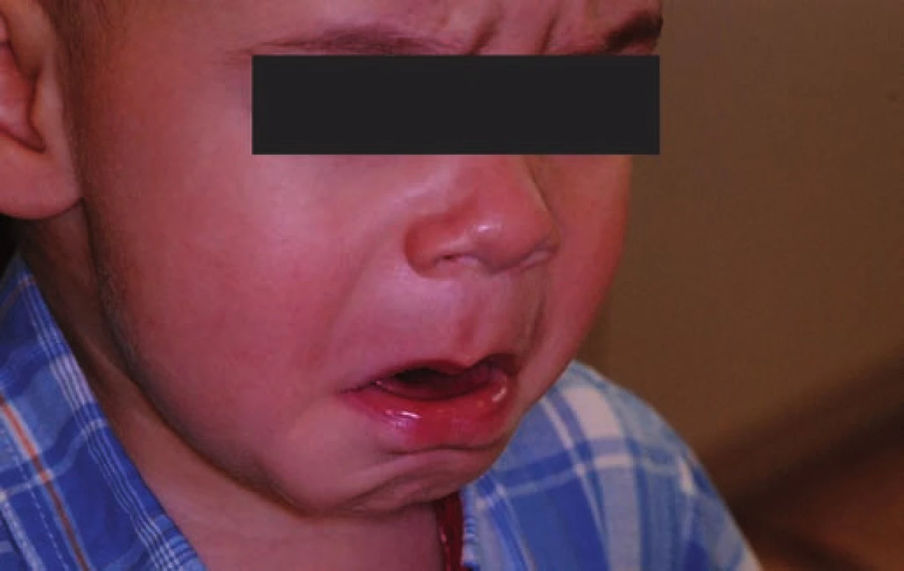 Dítě před podáním analgosedace.
Fig. 2. The child befor interpretation the analgosedation.