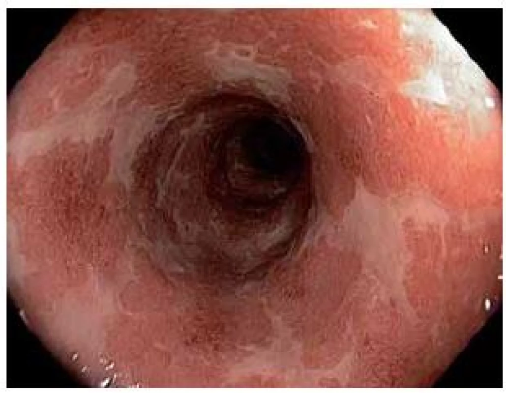 Levostranná kolitida, endoskopické Mayo subskore 3 – těžké postižení (spontánní krvácení,
ulcerace).
Fig. 2. Left-sided colitis, Mayo UC Endoscopic Score 
