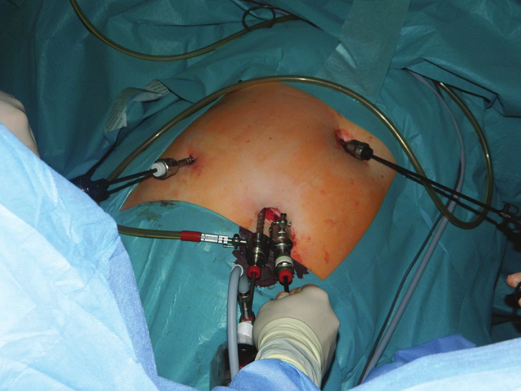 Konverze“ na laparoskopii z více vstupů
Fig. 3: “Conversion“ to multiple-ports laparoscopy