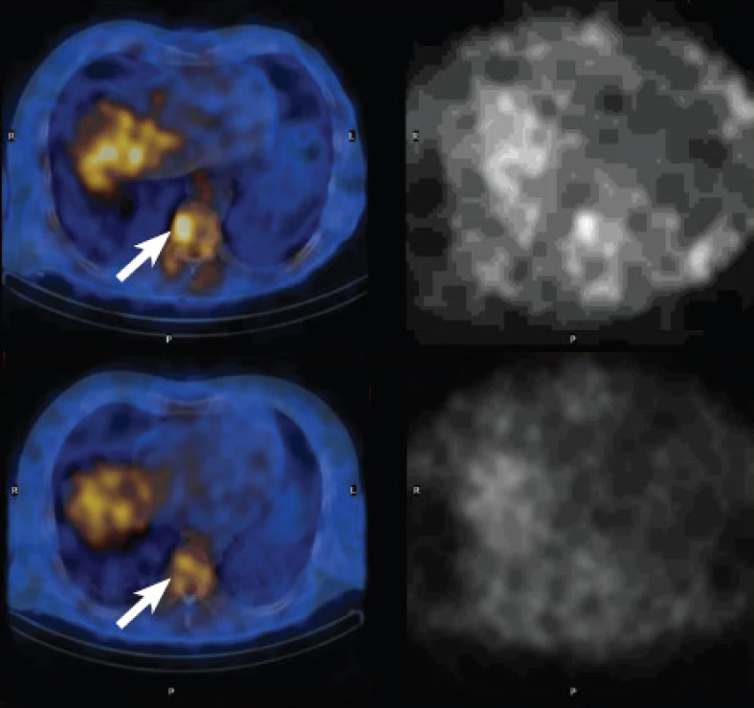 Srovnání SPECT/CT obrazů galliové scintigrafie. V horní polovině vyšetření v červnu 2011, v dolní polovině vyšetření v srpnu 2010, vlevo fúze SPECT/CT, vpravo SPECT. Je patrný nárůst akumulace 67Ga citrátu v pravé polovině obratlového těla Th9. Rovněž je patrné, že bez fúze obrazů je interpretace prakticky nemožná.
